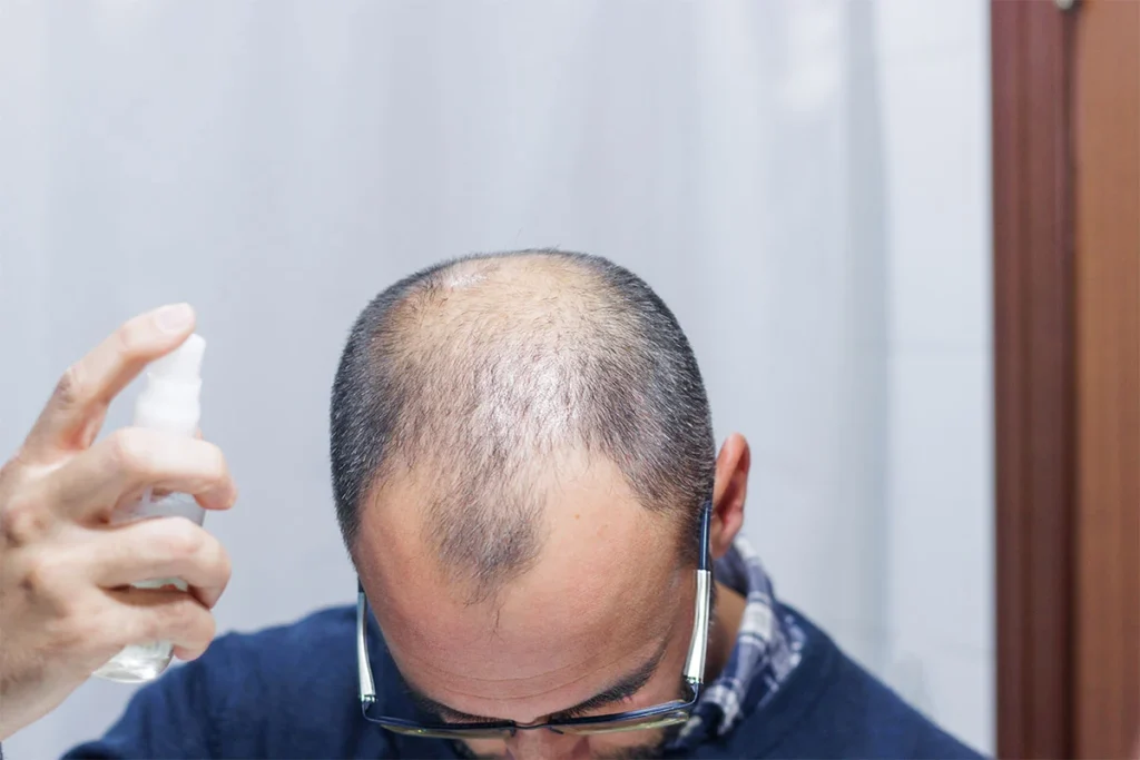 a man applying sunscreen to his scalp